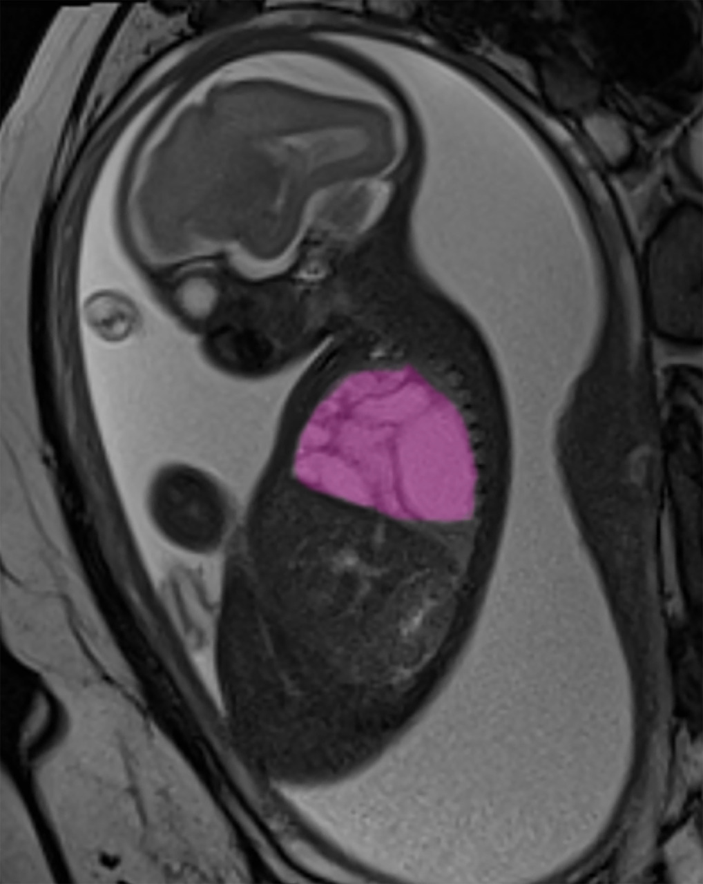 Intervento in utero per una cisti polmonare gigante