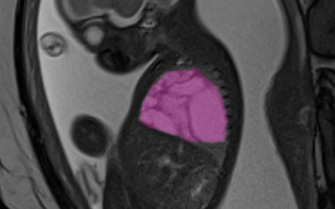 Intervento in utero per una cisti polmonare gigante